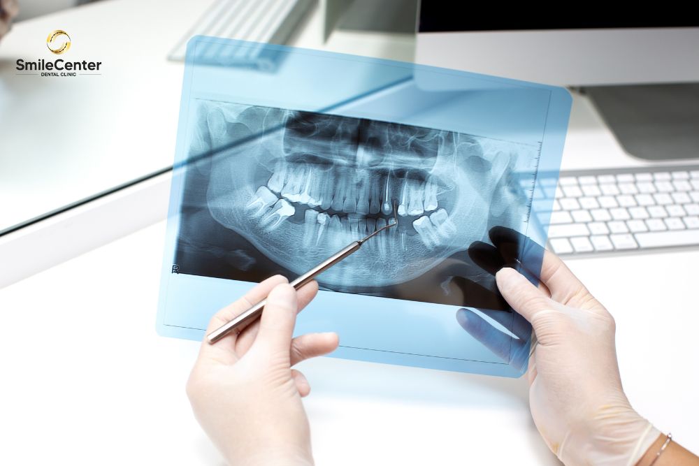 Chụp X-quang răng
