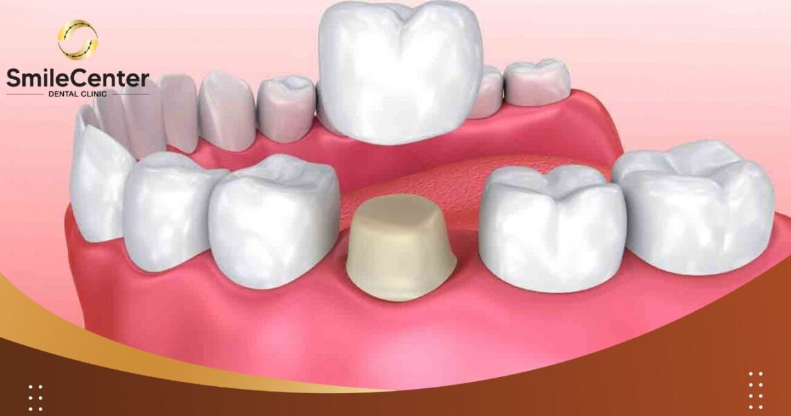 Bọc răng sứ giữ được bao lâu? Khi nào nên bọc răng sứ thẩm mỹ?