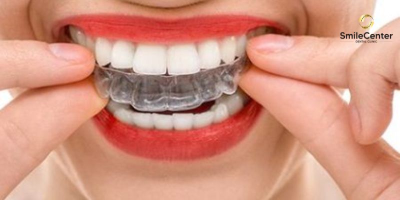 phương pháp niềng răng trong suốt clear aligners