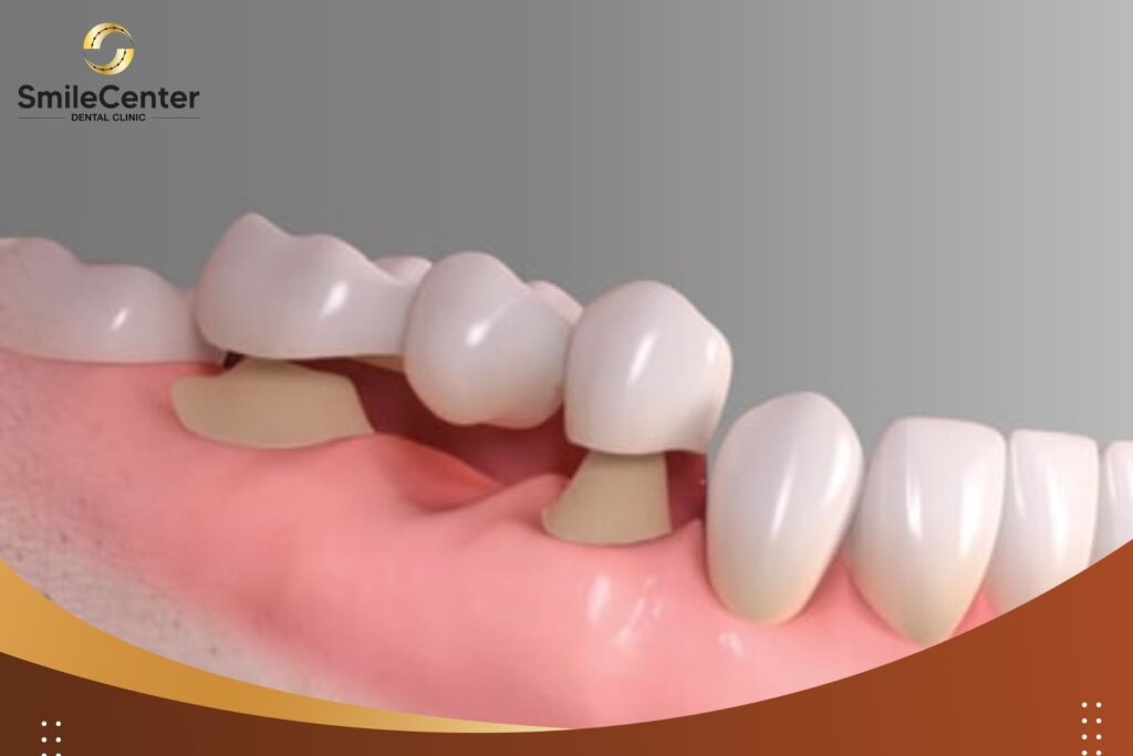 Tác dụng của cầu răng