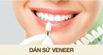 dán sứ veneer - wp
