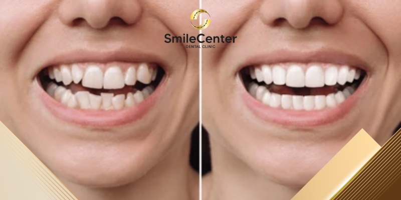 niềng răng trước và sau