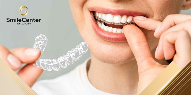 so sánh niềng răng truyền thông và niềng răng trong suốt