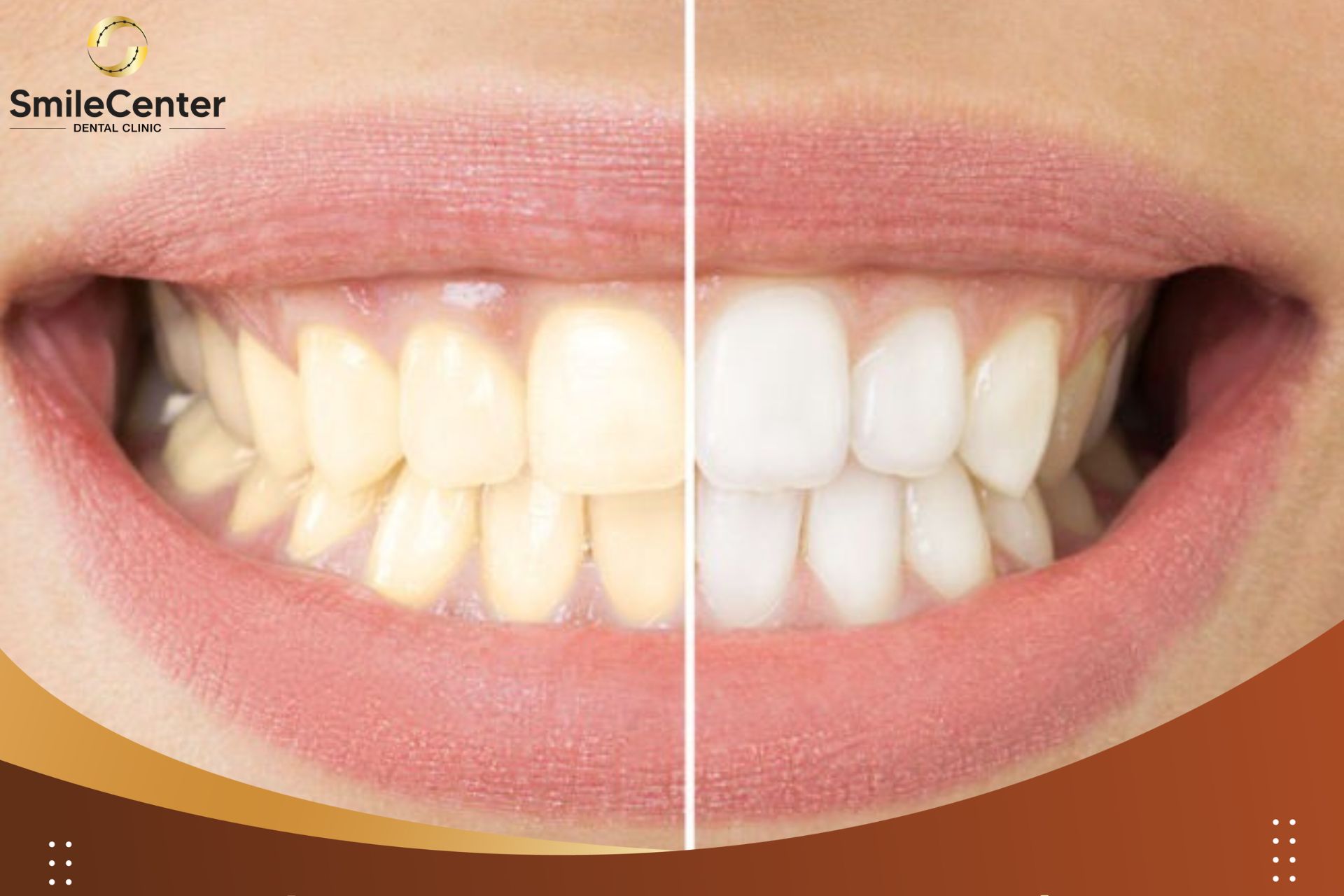 Tẩy trắng nha khoa - phương pháp làm trắng răng an toàn được lựa chọn