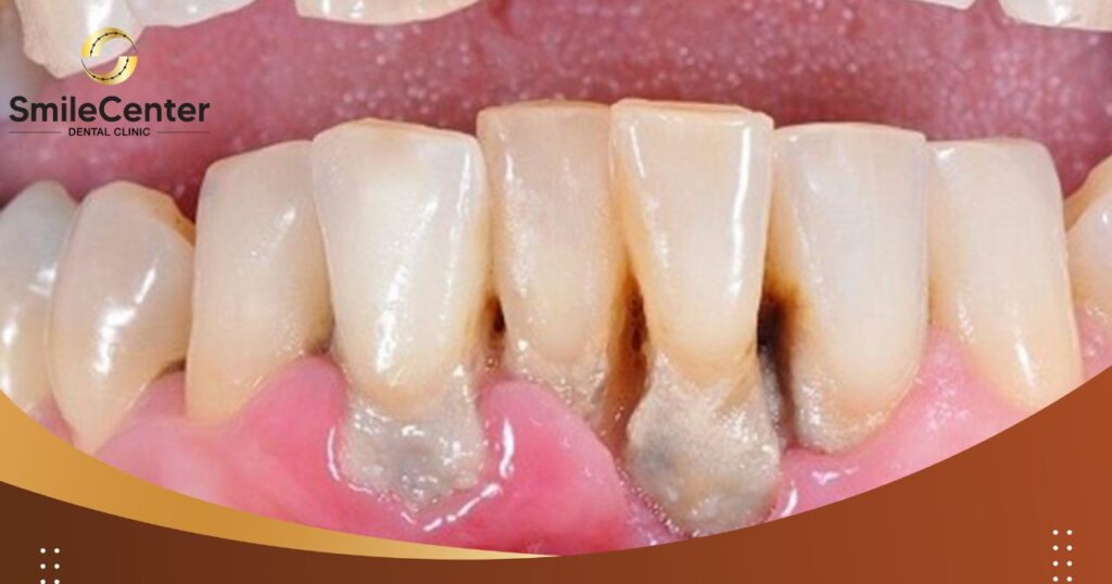 Viêm nha chu là gì? Một số thông tin cơ bản